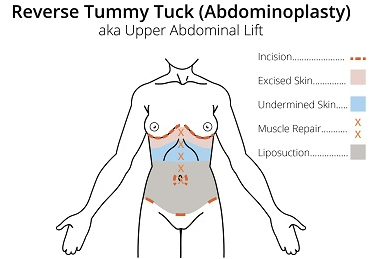 Reverse Tummy Tuck.png